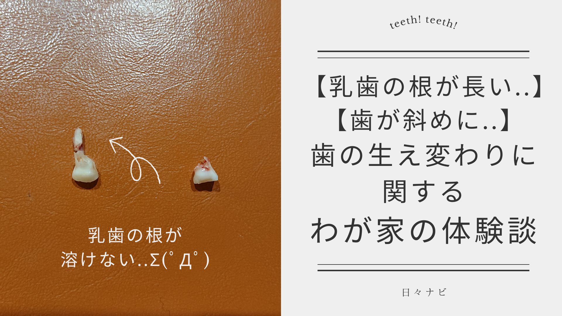 【体験談】子どもの上の前歯の永久歯が斜めに生えてきた。抜歯した乳歯の根が長かった件！